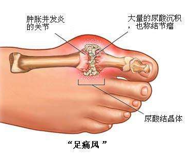 关于高尿酸血症与痛风